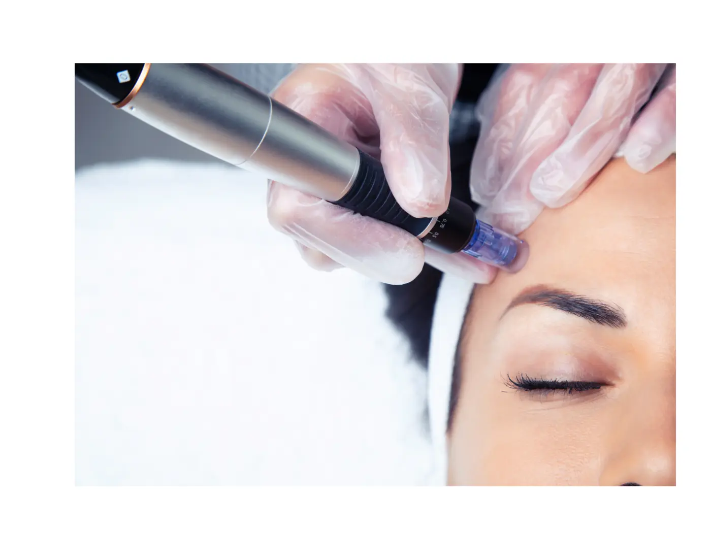 Microneedling et mésothérapie chez SOZAH BEAUTÉ